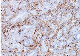 Células tumorales de cáncer de páncreas del modelo Kras.